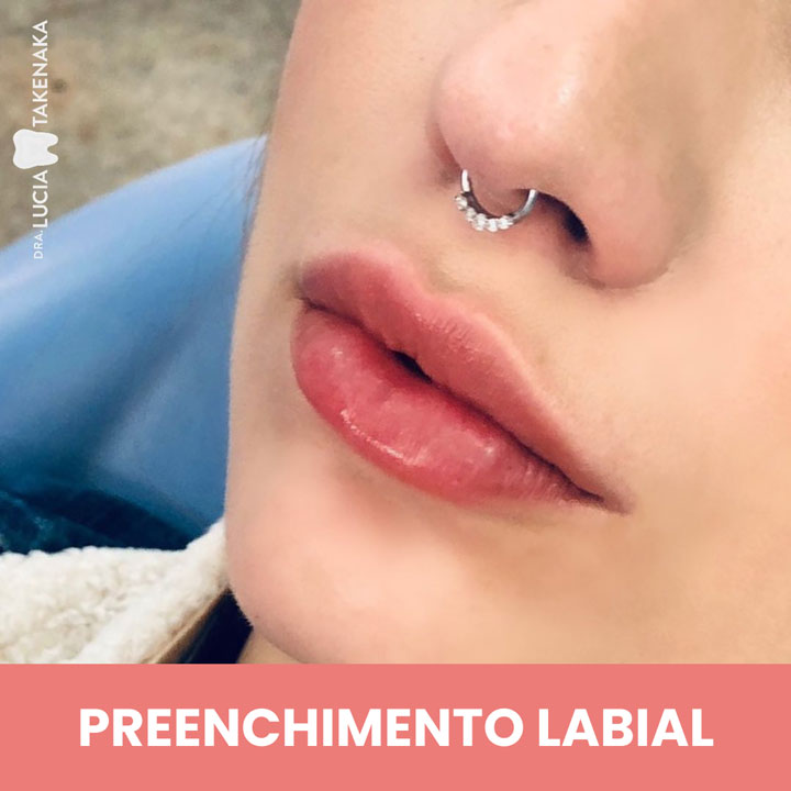 PREENCHIMENTO-LABIAL-1
