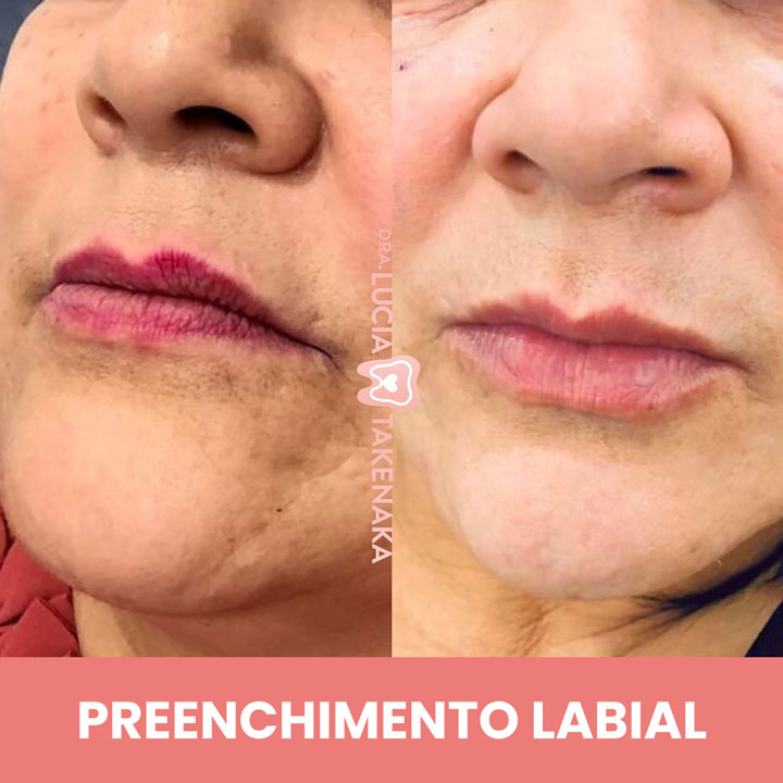 PREENCHIMENTO-LABIAL-2