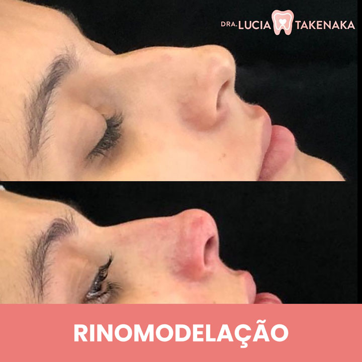 RINOMODELAÇÃO-1