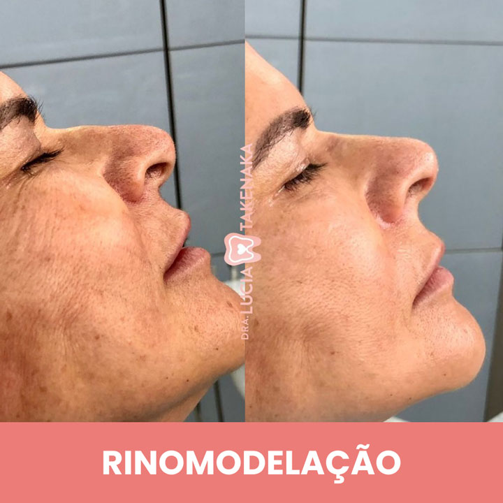RINOMODELAÇÃO-2