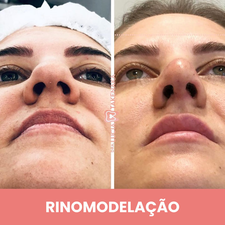 RINOMODELAÇÃO-3