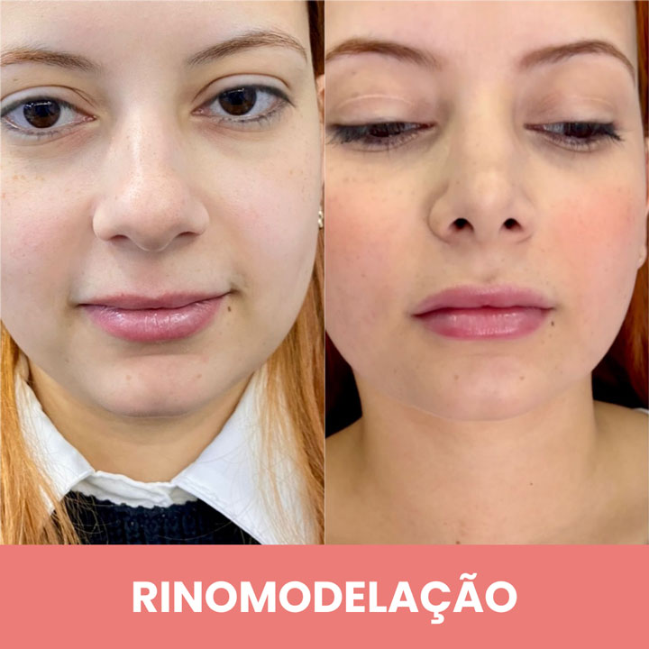 RINOMODELAÇÃO-4