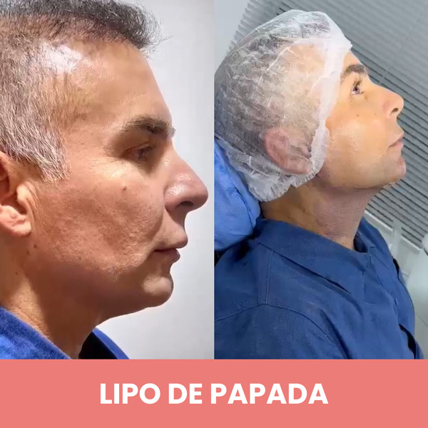 LIPO-DE-PAPADA-3